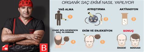 Organik Saç Ekimi Yaptıranlar ve Yorumları — Bilgi Doktoru.